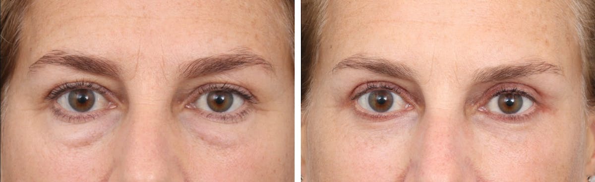 Blepharoplasty Before & After Gallery - Patient 73382049 - Image 1