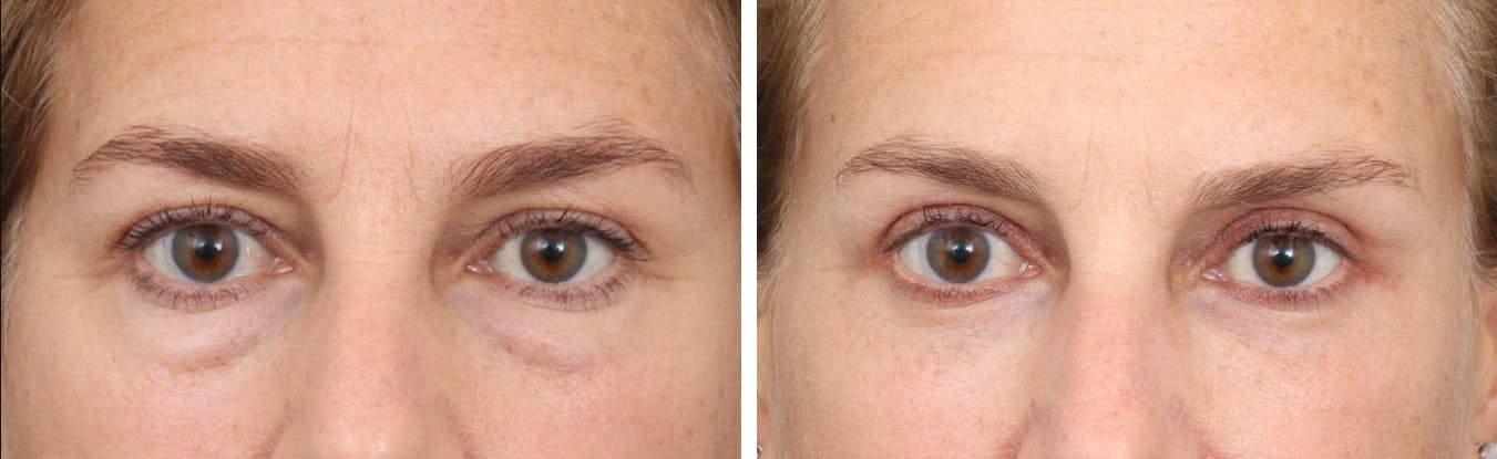 Blepharoplasty Before & After Gallery - Patient 73382049 - Image 1