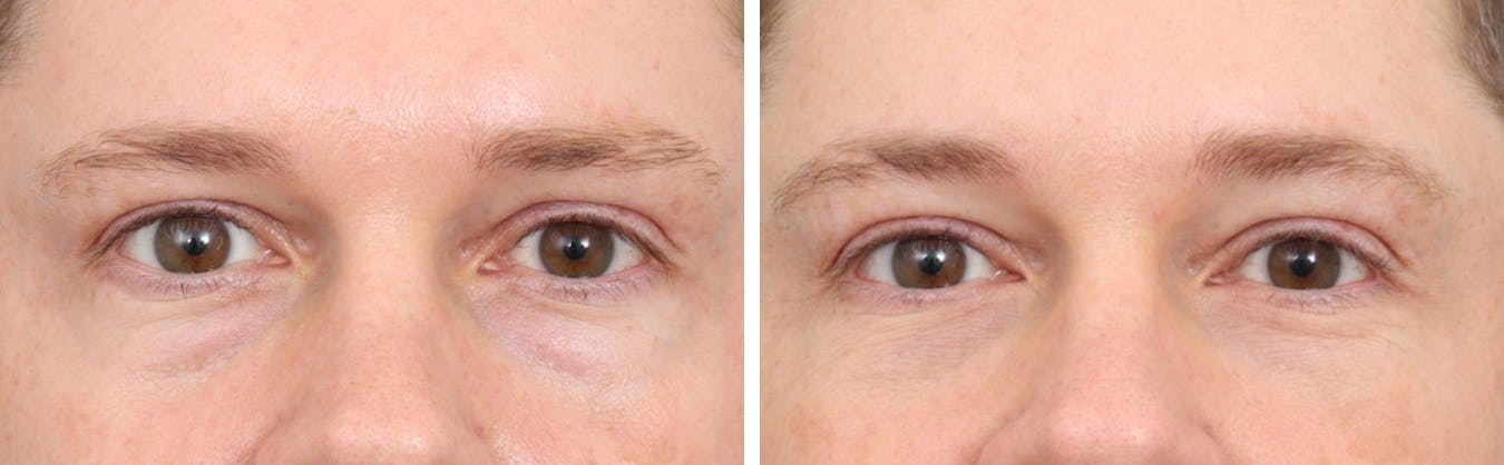 Blepharoplasty Before & After Gallery - Patient 64081098 - Image 1