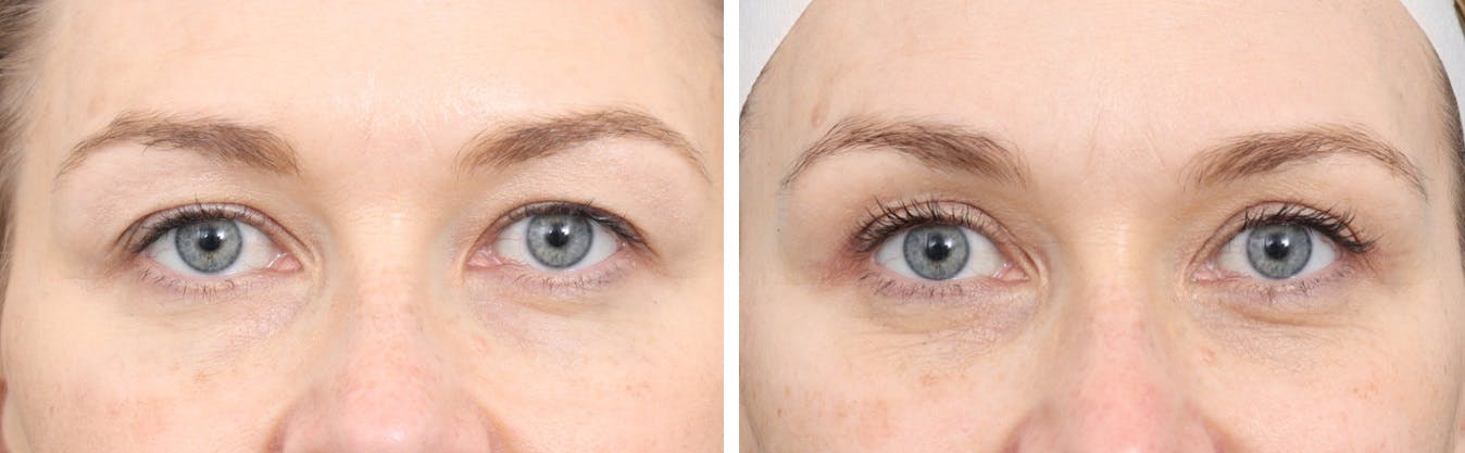 Blepharoplasty Before & After Gallery - Patient 64081096 - Image 1