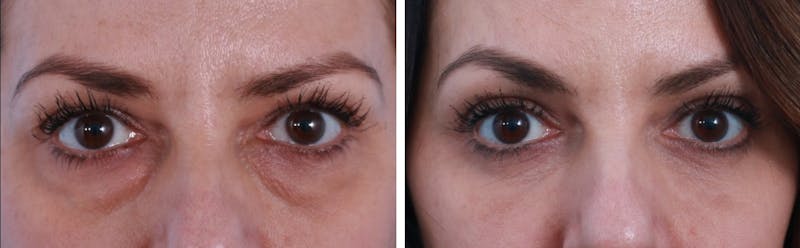 Blepharoplasty Before & After Gallery - Patient 64081087 - Image 1