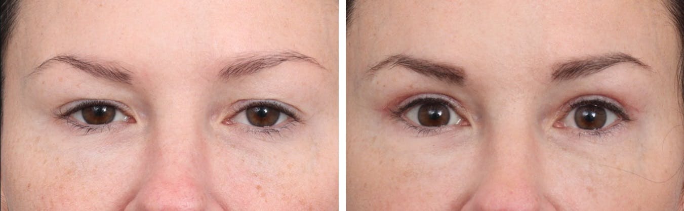 Blepharoplasty Before & After Gallery - Patient 64081089 - Image 1