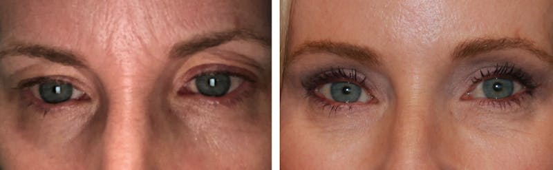 Blepharoplasty Before & After Gallery - Patient 64081088 - Image 1