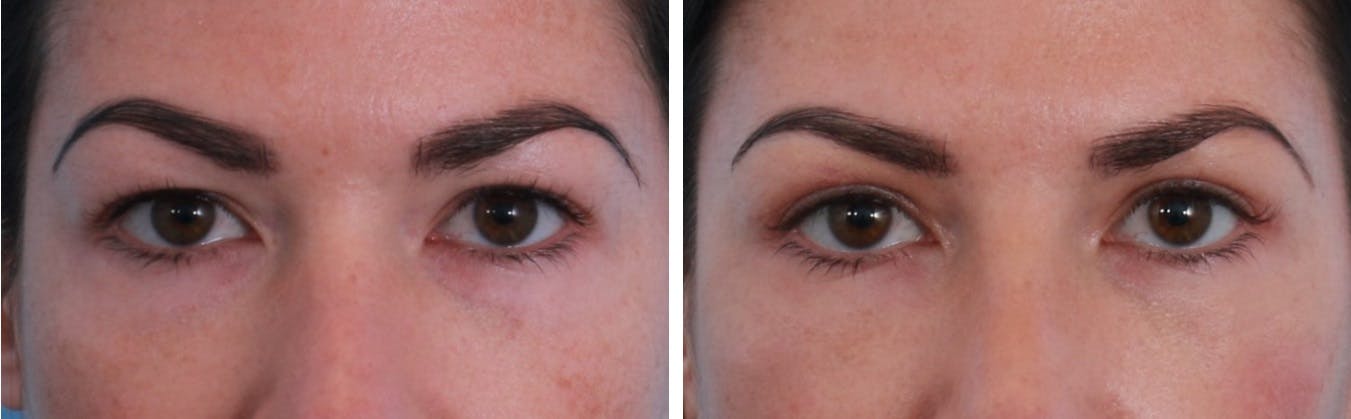 Blepharoplasty Before & After Gallery - Patient 64081107 - Image 1