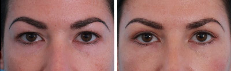 Blepharoplasty Before & After Gallery - Patient 64081107 - Image 1