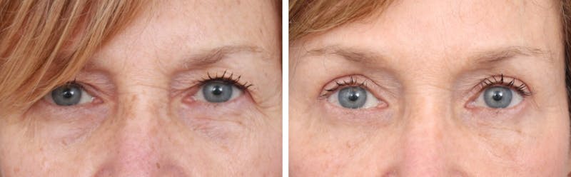 Blepharoplasty Before & After Gallery - Patient 64081090 - Image 1