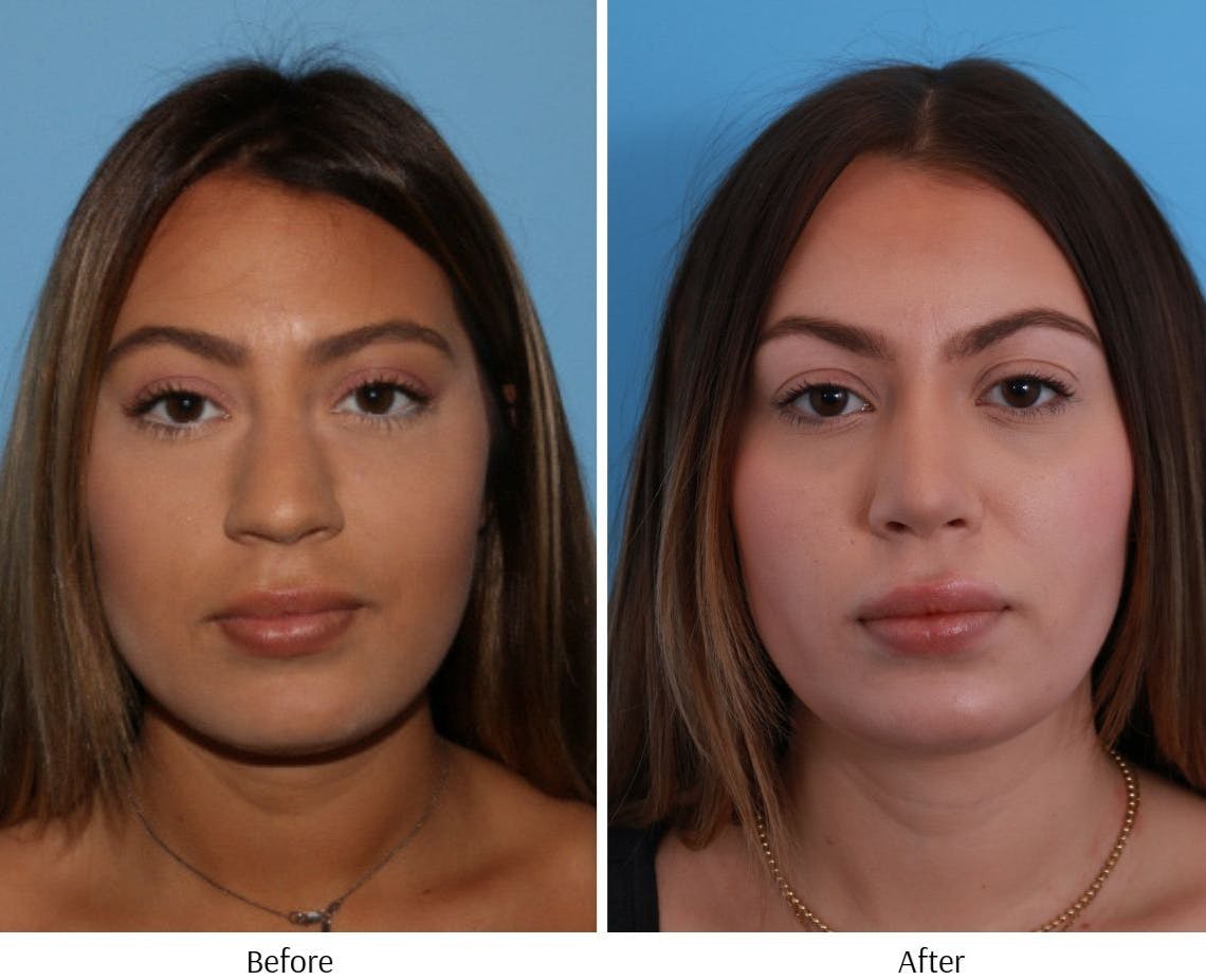 Rhinoplasty Before & After Gallery - Patient 64080944 - Image 2