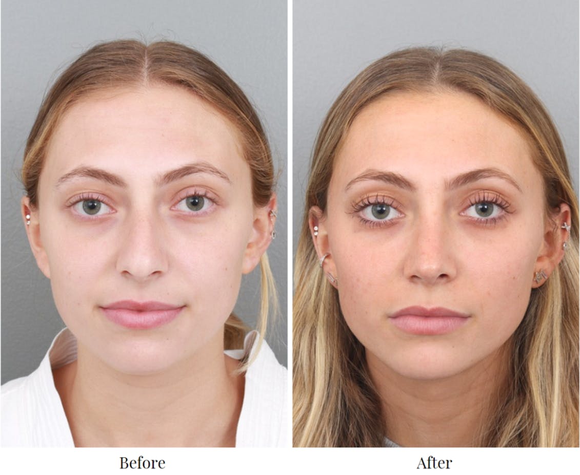 Rhinoplasty Before & After Gallery - Patient 64080943 - Image 2