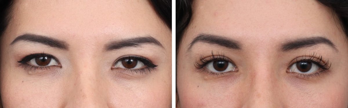 Brow Lift Before & After Gallery - Patient 73412836 - Image 1