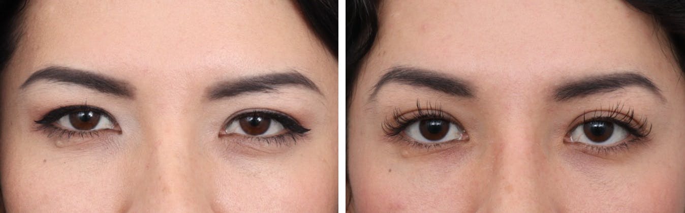 Brow Lift Before & After Gallery - Patient 73412836 - Image 1