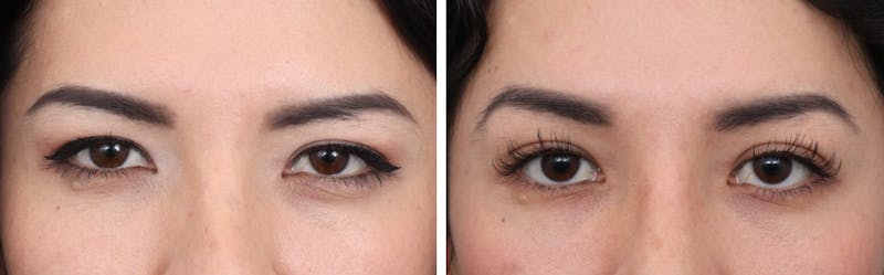 Brow Lift Before & After Gallery - Patient 73412836 - Image 1