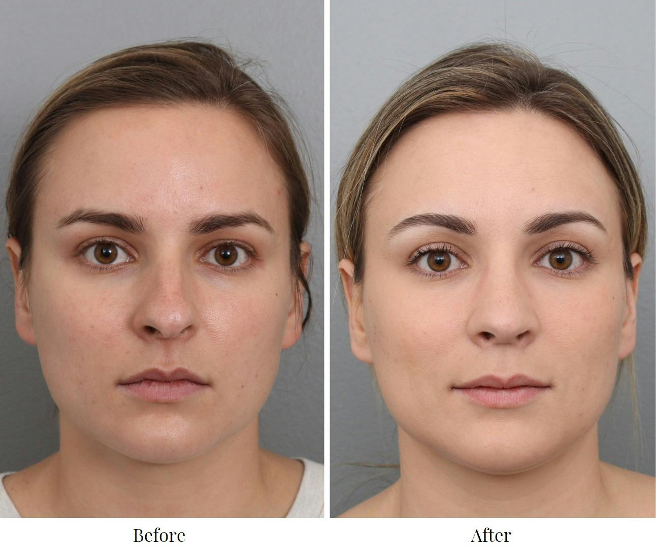 Rhinoplasty Before & After Gallery - Patient 73471215 - Image 3