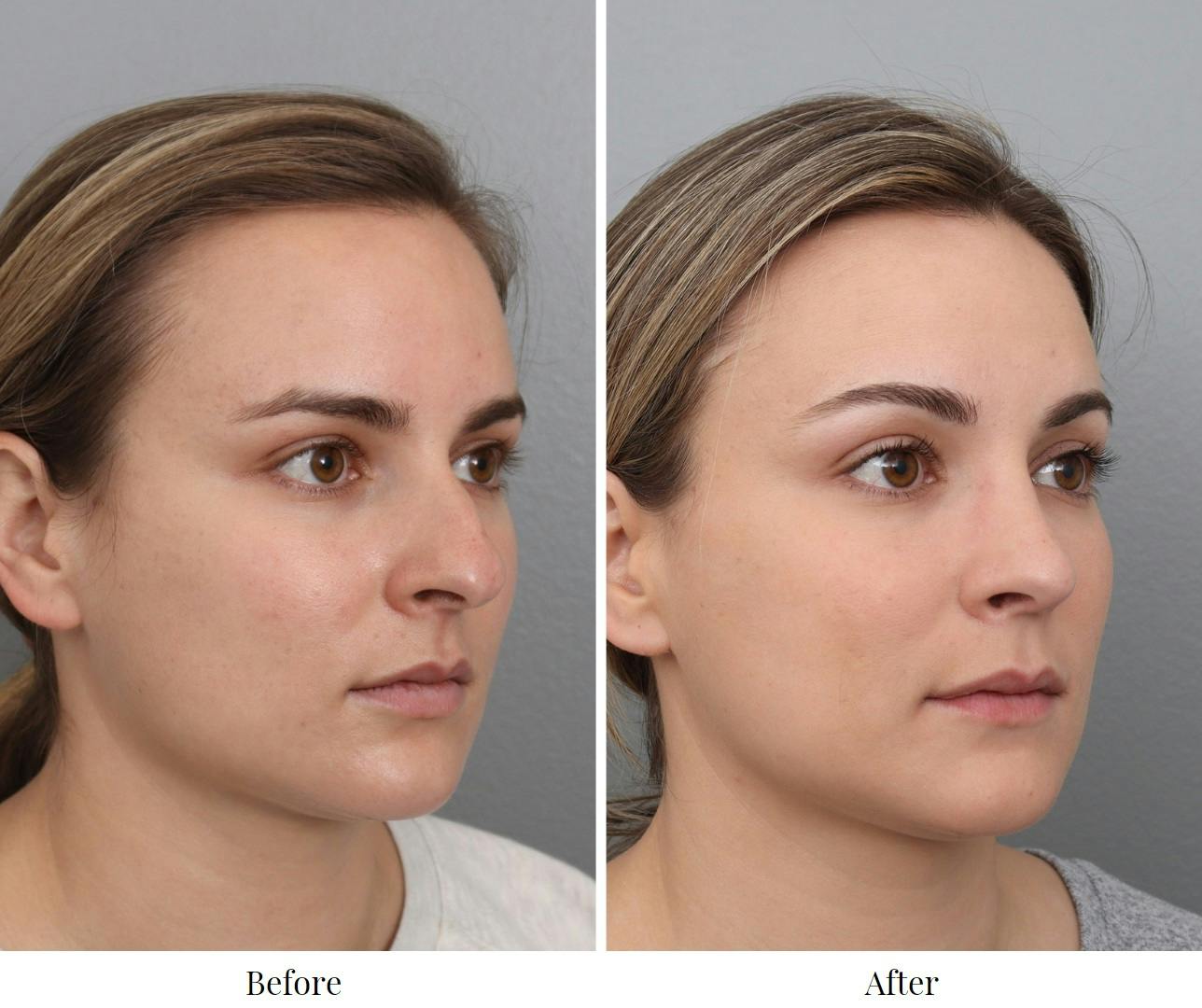 Rhinoplasty Before & After Gallery - Patient 73471215 - Image 3