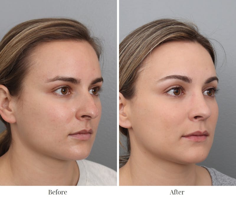 Rhinoplasty Before & After Gallery - Patient 73471215 - Image 1