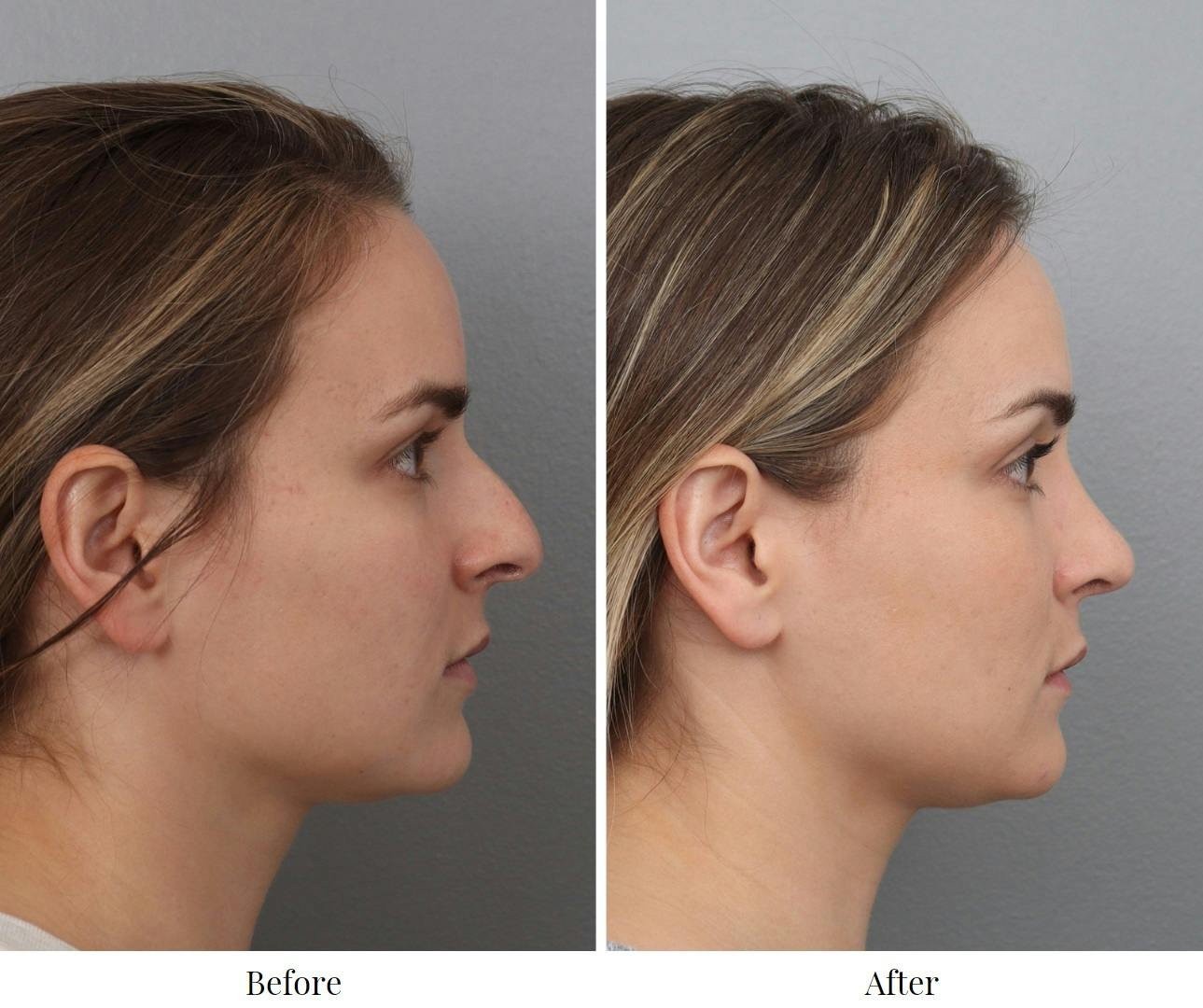 Rhinoplasty Before & After Gallery - Patient 73471215 - Image 1