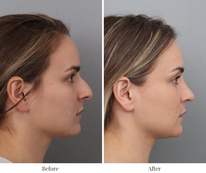 Rhinoplasty Before & After Gallery - Patient 73471215 - Image 1