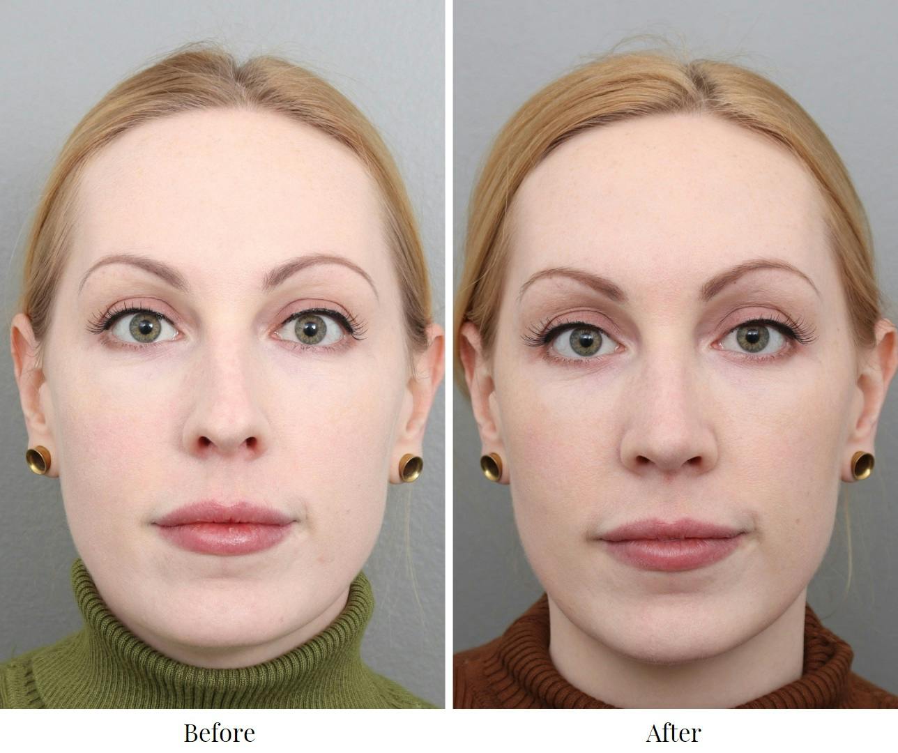 Rhinoplasty Before & After Gallery - Patient 73471214 - Image 2