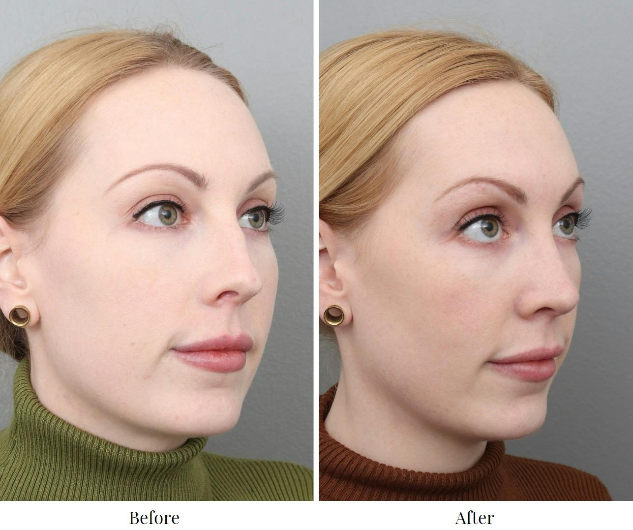 Rhinoplasty Before & After Gallery - Patient 73471214 - Image 1