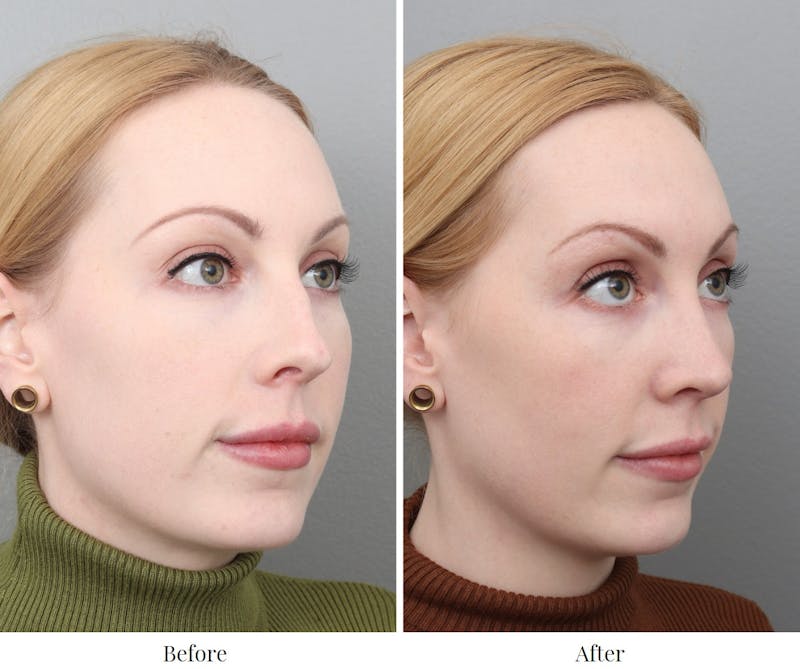 Rhinoplasty Before & After Gallery - Patient 73471214 - Image 1