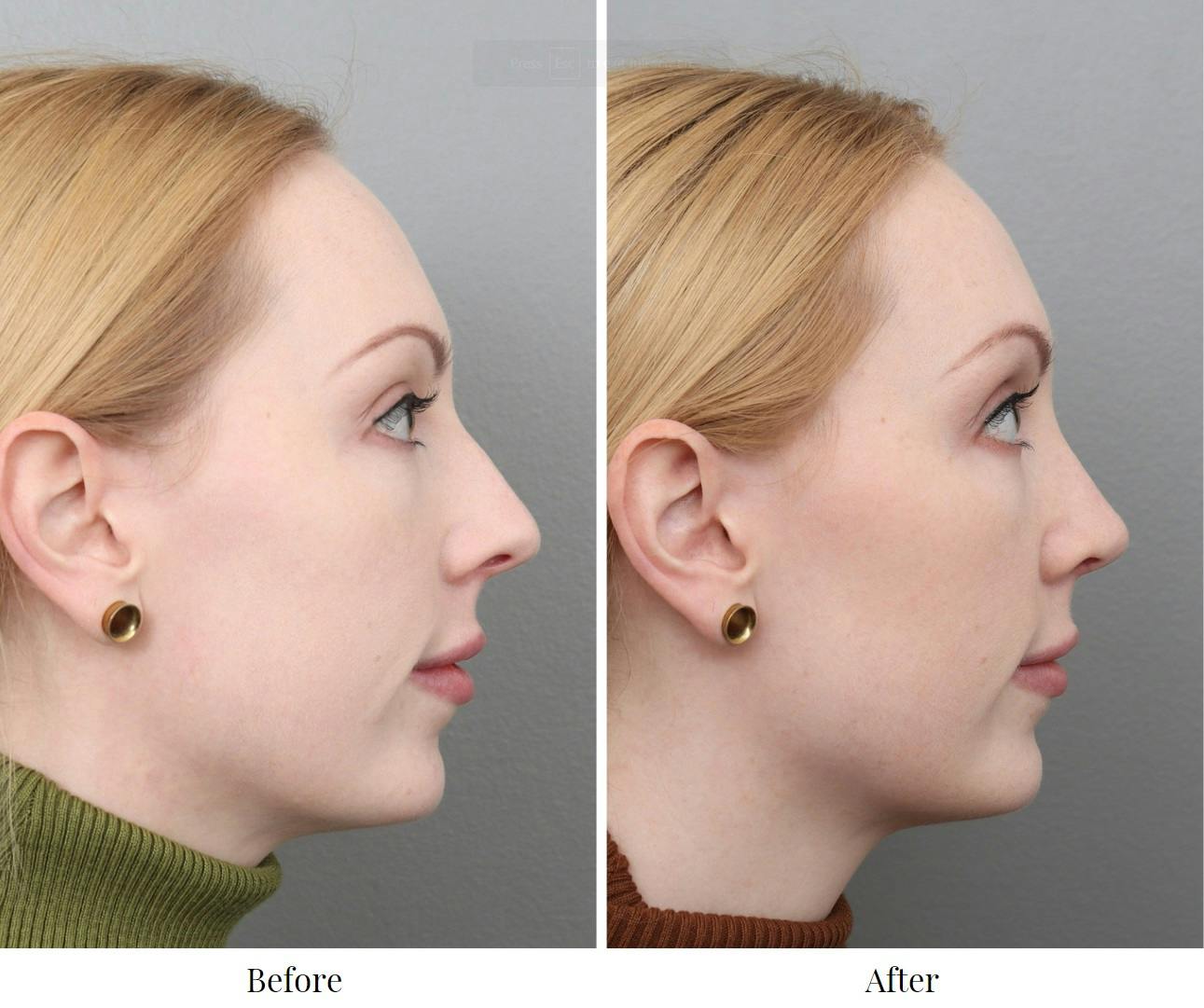 Rhinoplasty Before & After Gallery - Patient 73471214 - Image 3