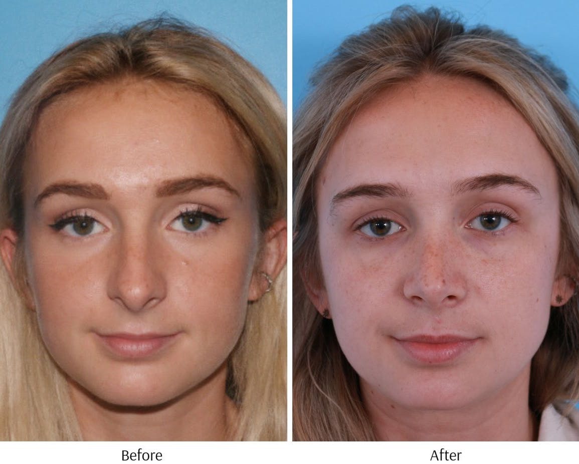 Rhinoplasty Before & After Gallery - Patient 64080945 - Image 2