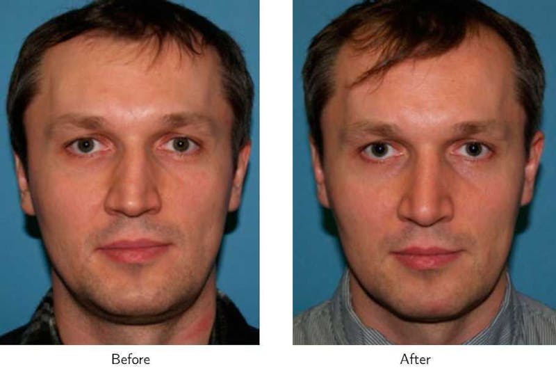 Rhinoplasty Before & After Gallery - Patient 64081050 - Image 1