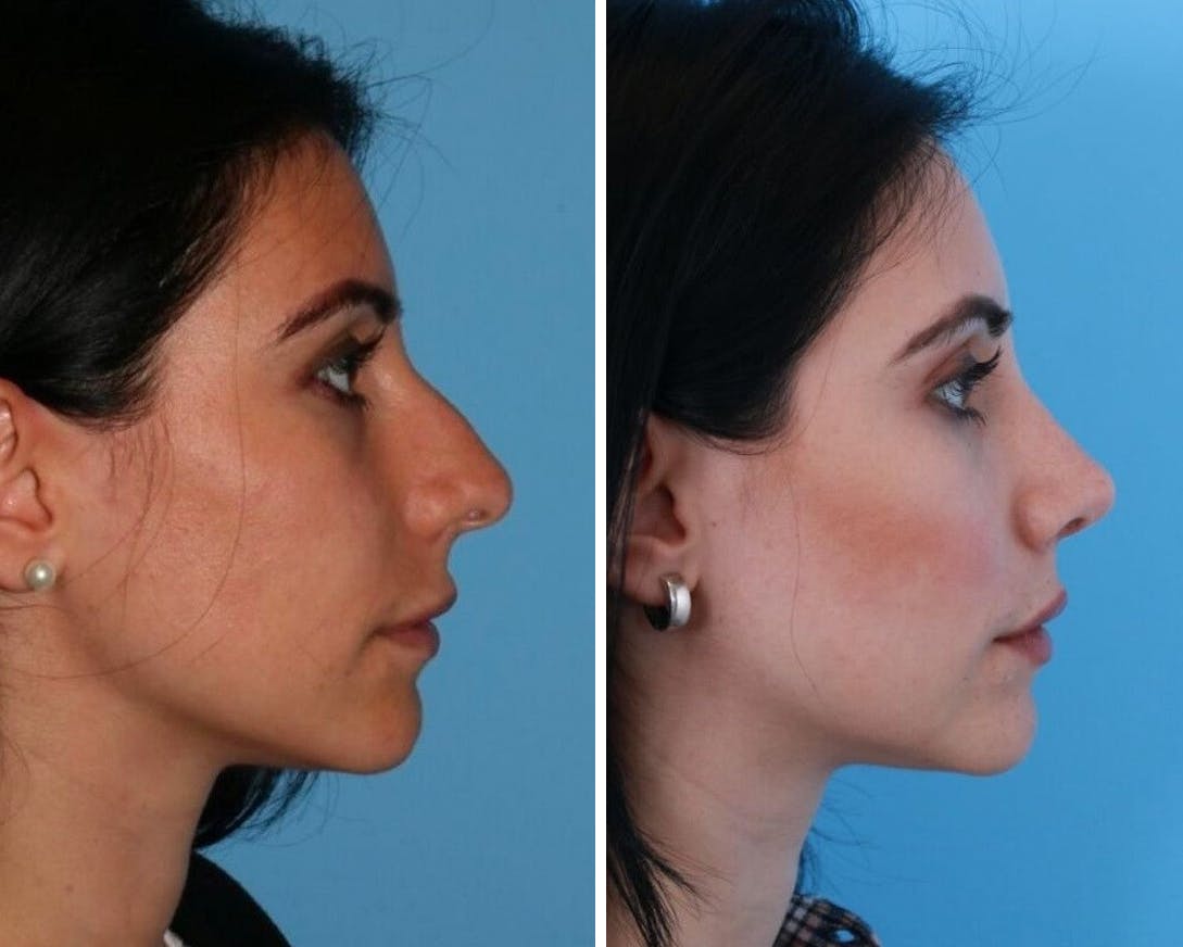 Rhinoplasty Before & After Gallery - Patient 64080946 - Image 1