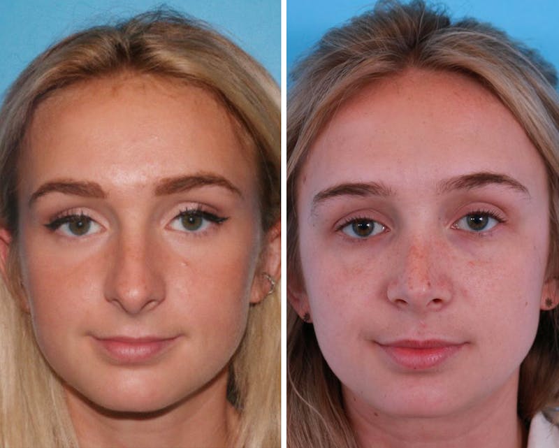 Rhinoplasty Before & After Gallery - Patient 64080945 - Image 1