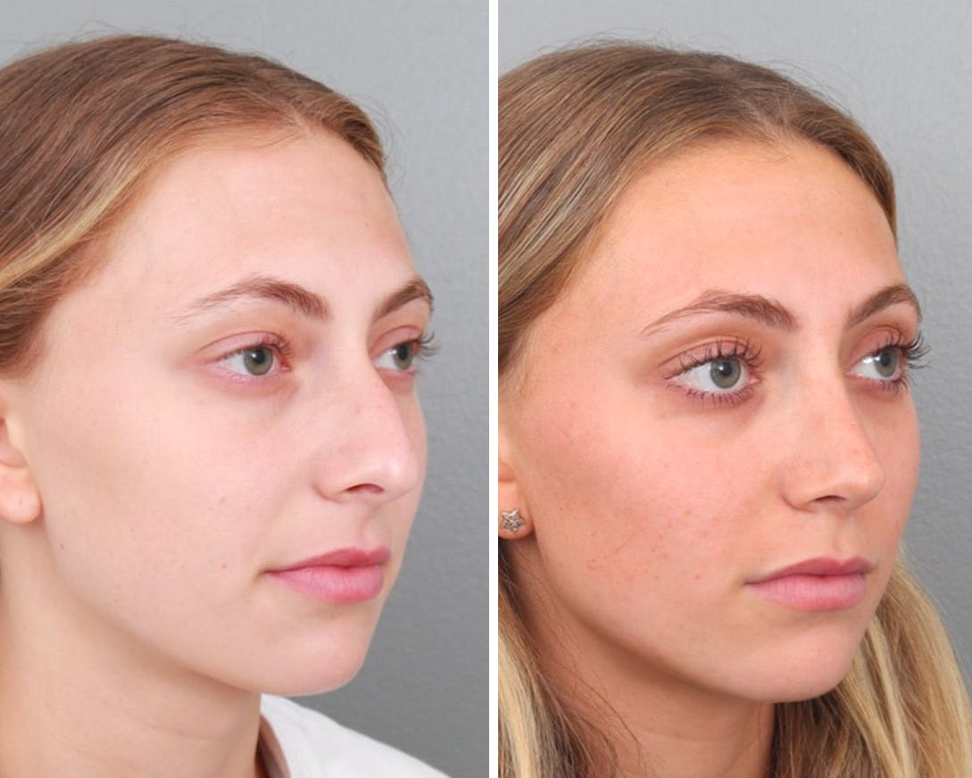 Rhinoplasty Before & After Gallery - Patient 64080943 - Image 1