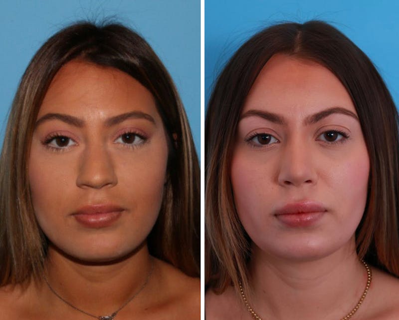 Rhinoplasty Before & After Gallery - Patient 64080944 - Image 1