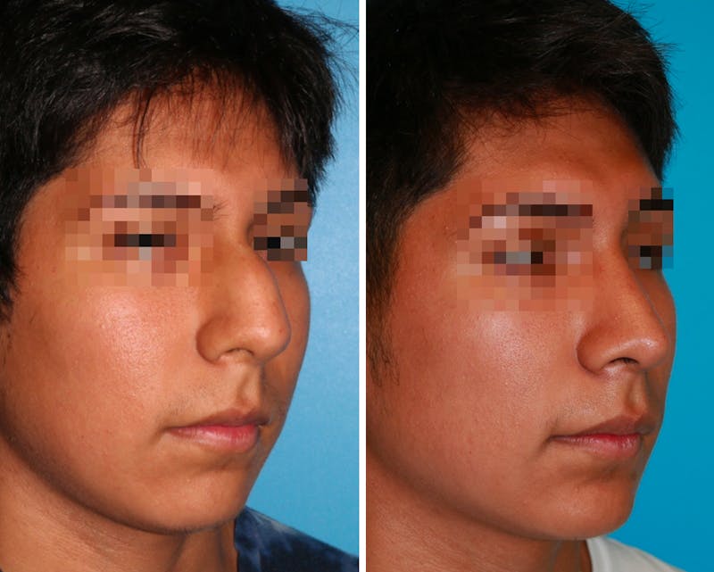 Rhinoplasty Before & After Gallery - Patient 64080947 - Image 1