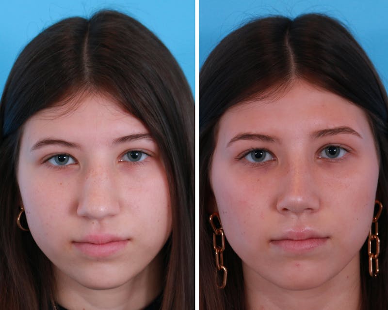 Rhinoplasty Before & After Gallery - Patient 64080948 - Image 1