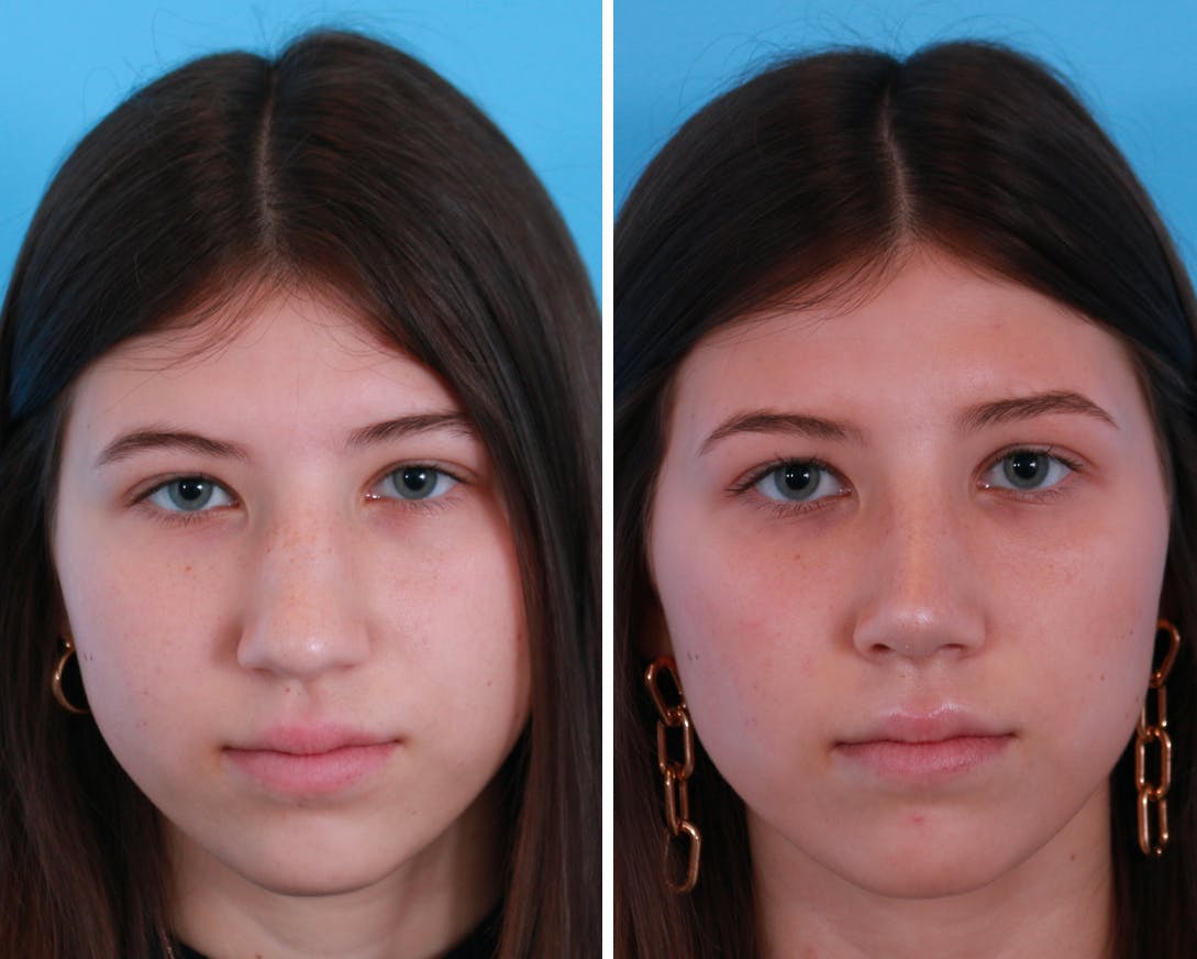 Rhinoplasty Before & After Gallery - Patient 64080948 - Image 1