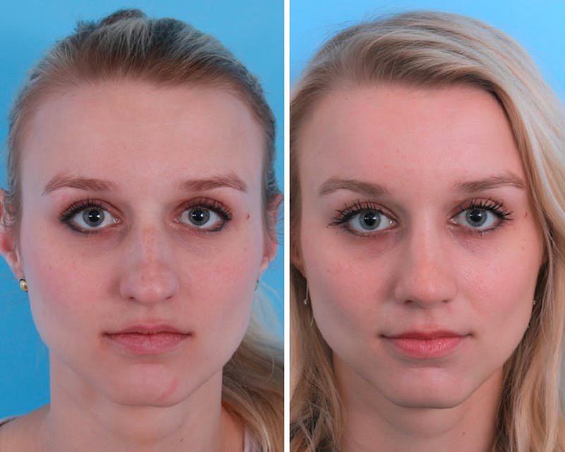 Rhinoplasty Before & After Gallery - Patient 64080952 - Image 1