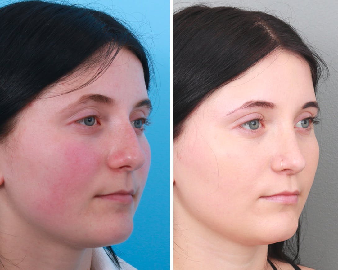 Rhinoplasty Before & After Gallery - Patient 64080970 - Image 1