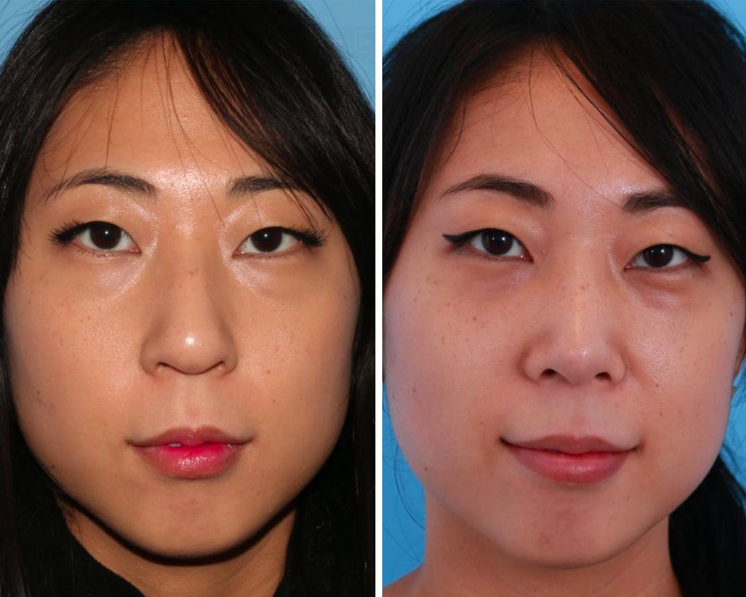 Rhinoplasty Before & After Gallery - Patient 64080953 - Image 1