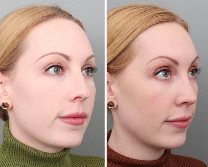 Rhinoplasty Before & After Gallery - Patient 73471214 - Image 1