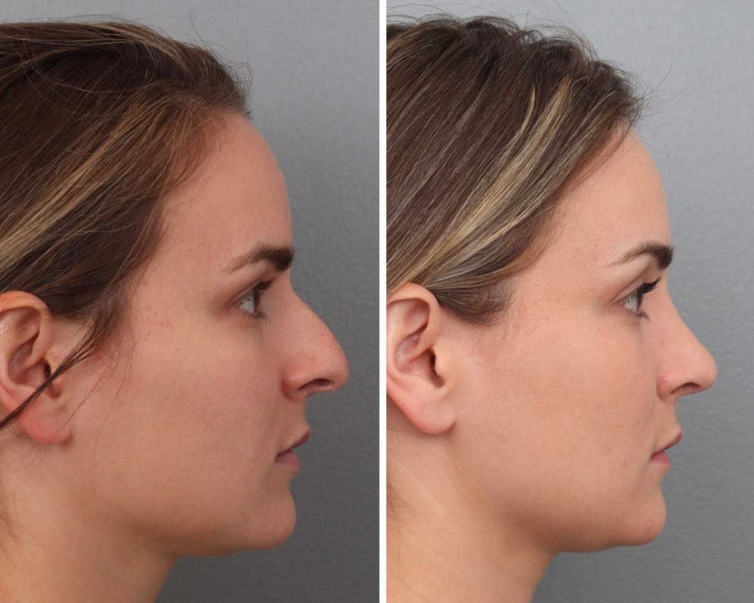 Rhinoplasty Before & After Gallery - Patient 73471215 - Image 2