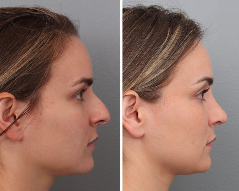 Rhinoplasty Before & After Gallery - Patient 73471215 - Image 1
