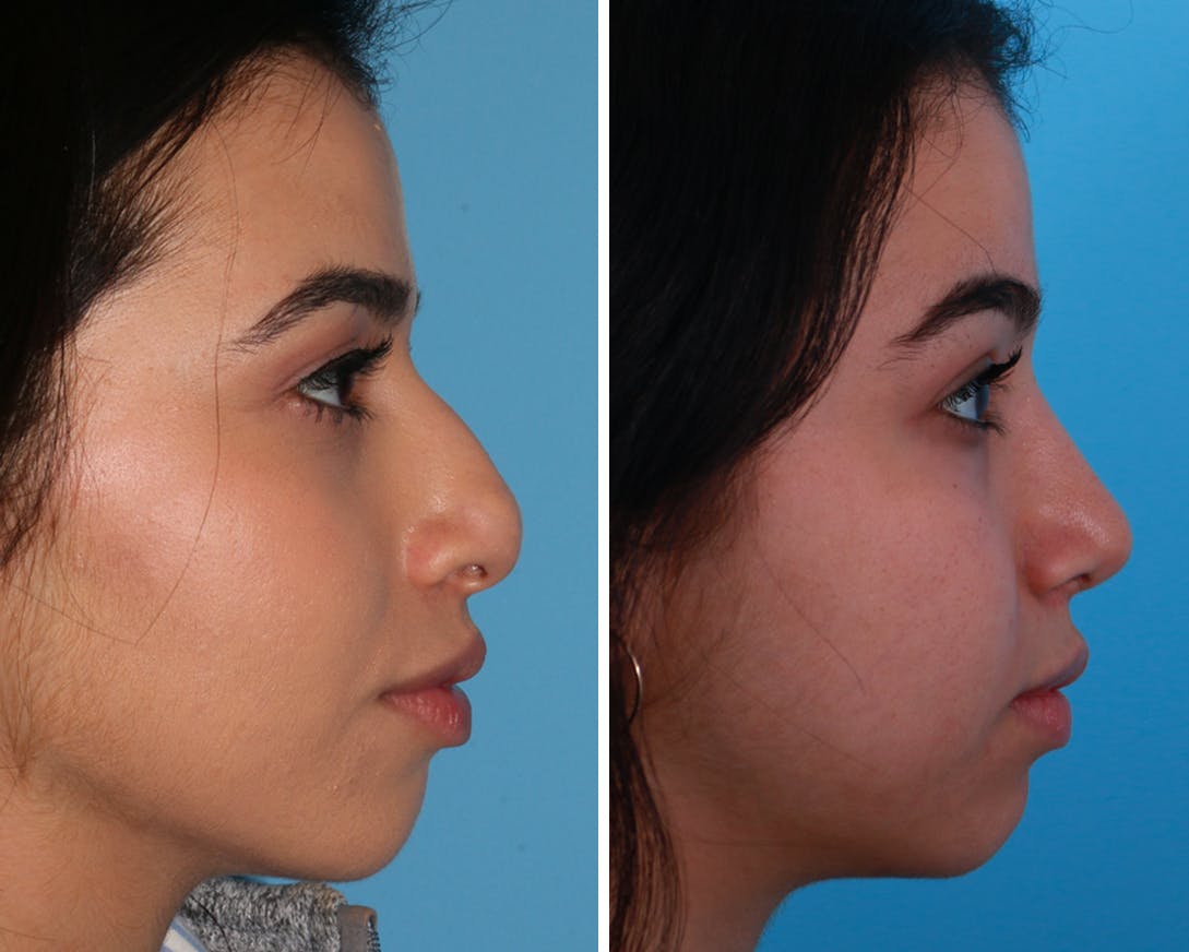 Rhinoplasty Before & After Gallery - Patient 64080957 - Image 1