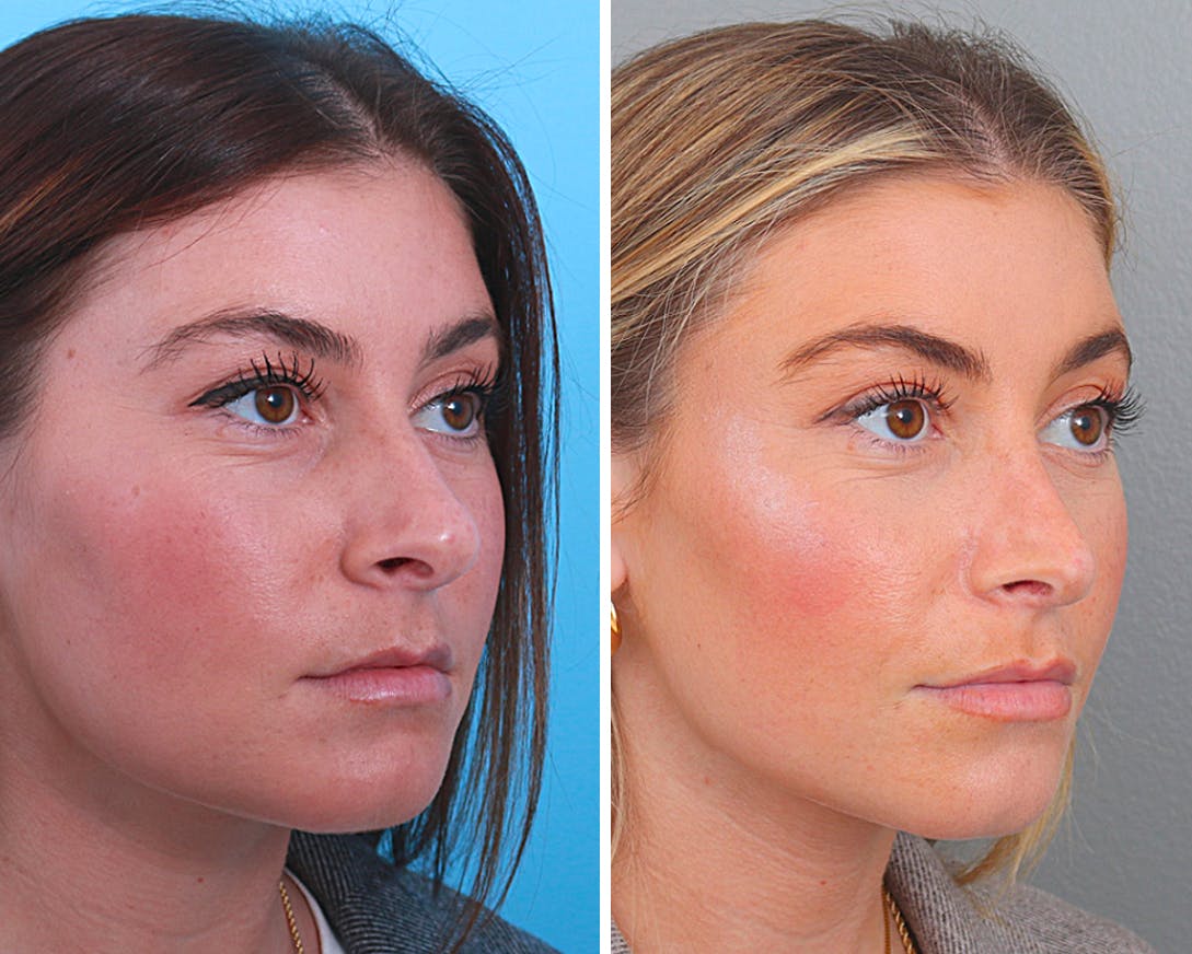 Rhinoplasty Before & After Gallery - Patient 64080964 - Image 1