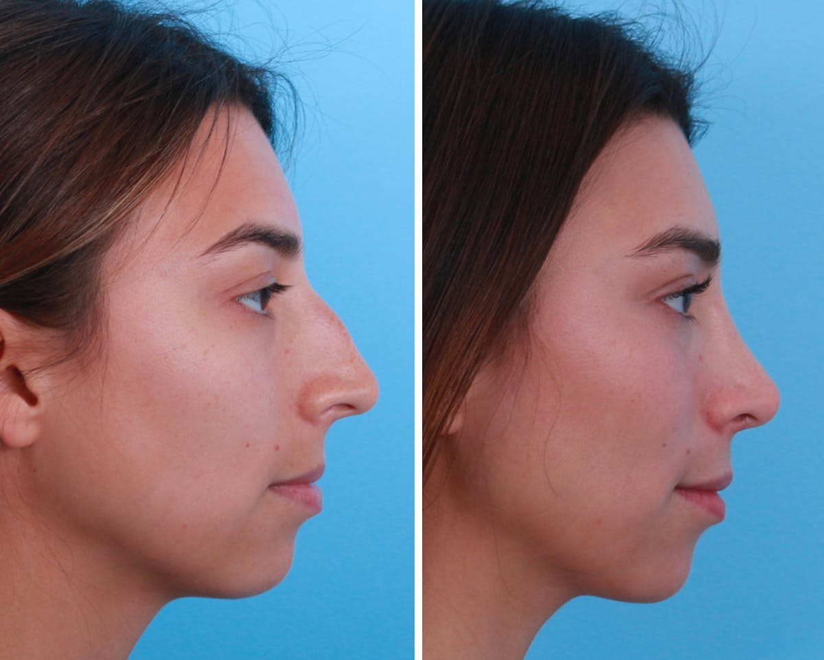 Rhinoplasty Before & After Gallery - Patient 64080965 - Image 1