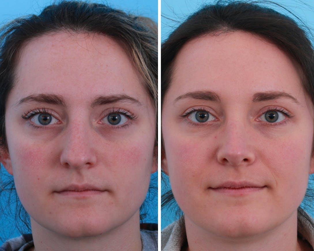 Rhinoplasty Before & After Gallery - Patient 64080966 - Image 1