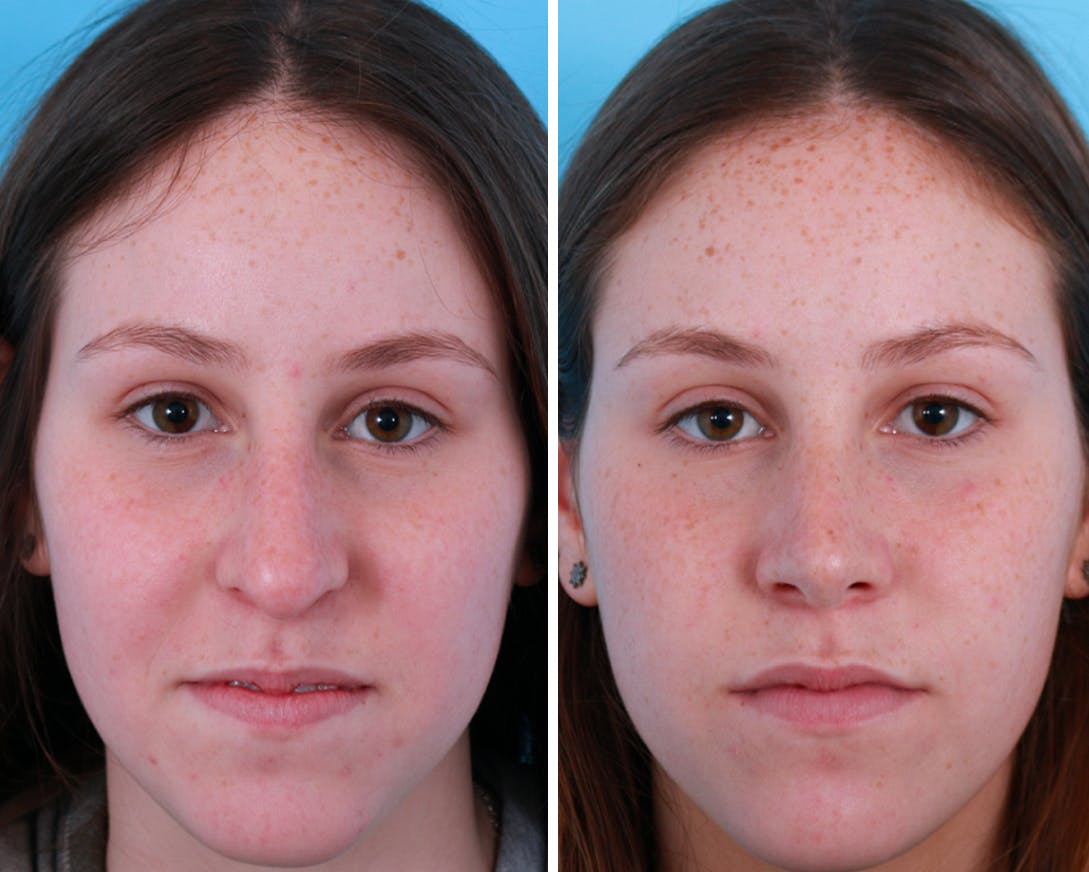 Rhinoplasty Before & After Gallery - Patient 64080961 - Image 1