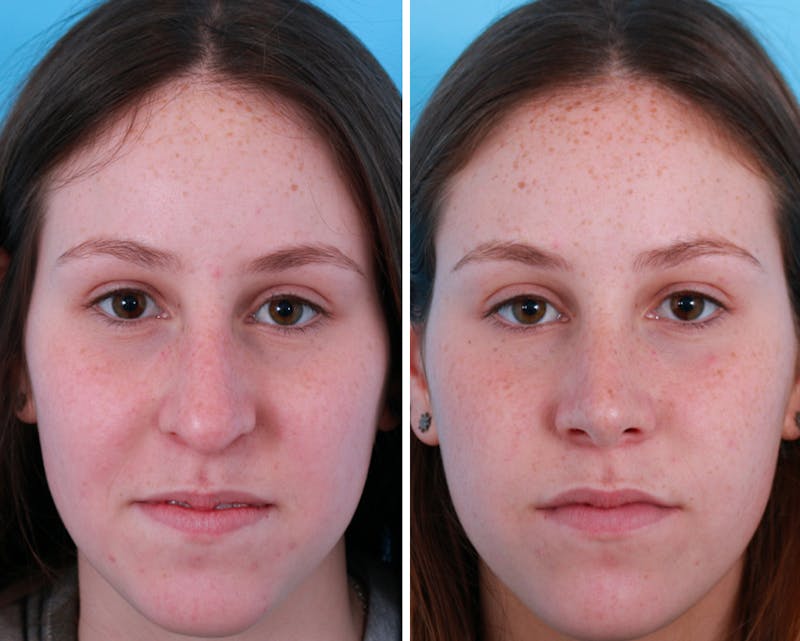 Rhinoplasty Before & After Gallery - Patient 64080961 - Image 1