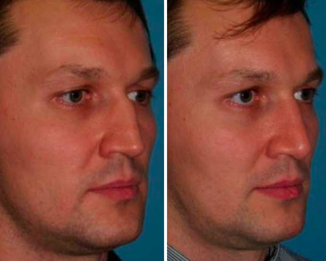 Rhinoplasty Before & After Gallery - Patient 64081050 - Image 1