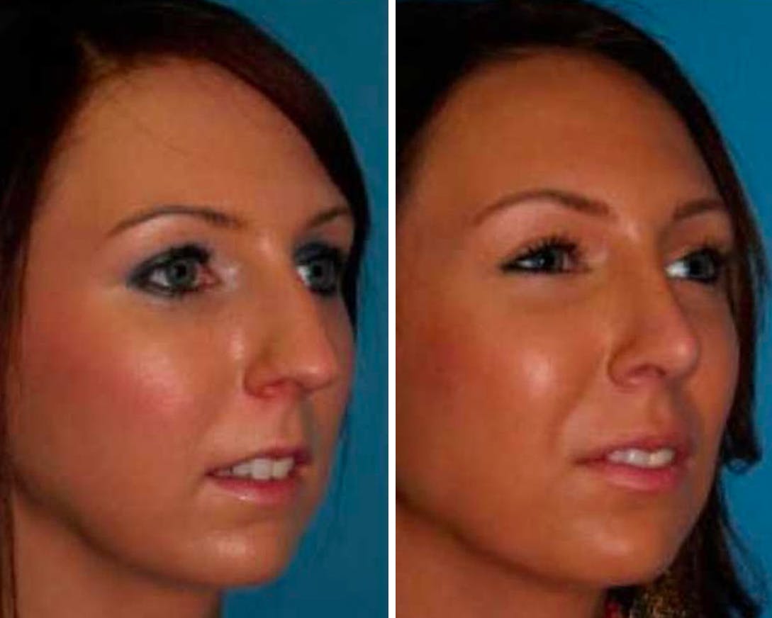 Rhinoplasty Before & After Gallery - Patient 64081053 - Image 1