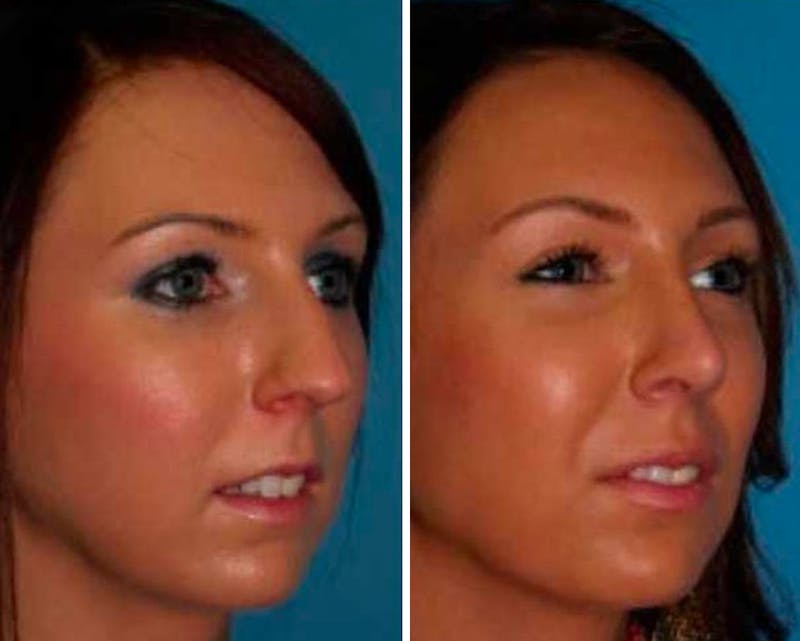 Rhinoplasty Before & After Gallery - Patient 64081053 - Image 1