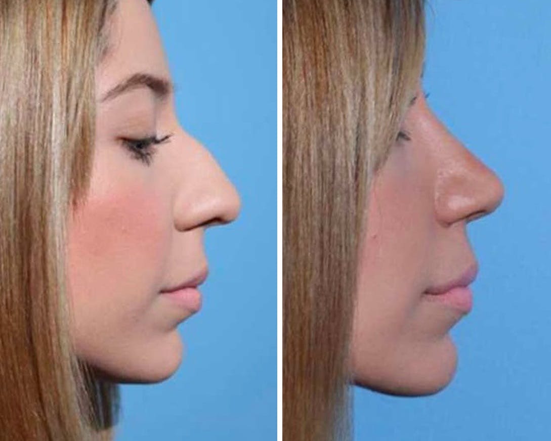 Rhinoplasty Before & After Gallery - Patient 64081032 - Image 1