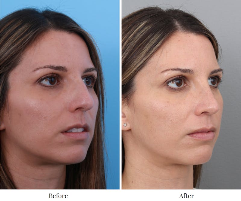 Rhinoplasty Before & After Gallery - Patient 64081023 - Image 1